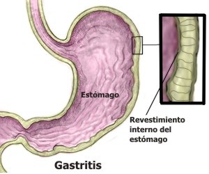 Síntomas más comunes de la gastritis